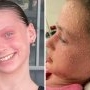 O fetiță de 11 ani este alergică la propriile lacrimi și transpirație