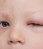De ce se umflă ochii la copii: cauze, tratament și prevenție