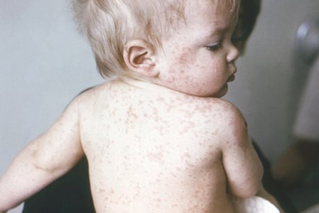 Epidemia de rujeola din SUA confirma: Vaccineaza-ti copilul!