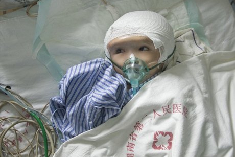 Premiera medicala: unei fetite din China i-a fost inlocuit craniul anormal cu un model realizat de imprimante 3D