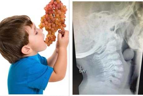 De ce nu trebuie să lăsăm copiii să mănânce struguri nesupravegheat? O radiografie terifiantă răspunde!