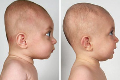 Capul turtit (plagiocefalia pozitionala) la bebelusi