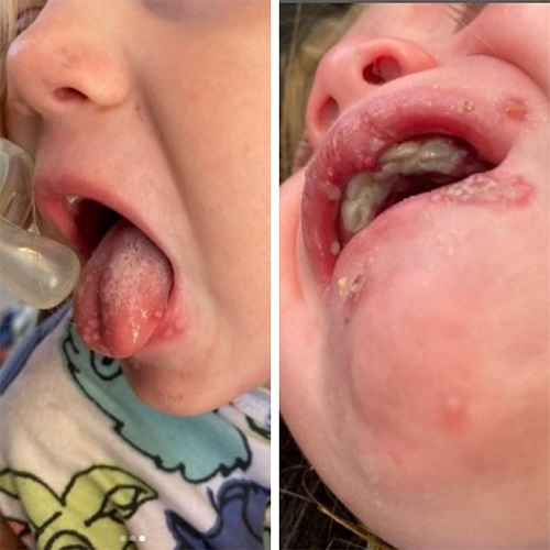 fetita-care-se-confrunta-cu-leziuni-herpetice-in-zona-gurii