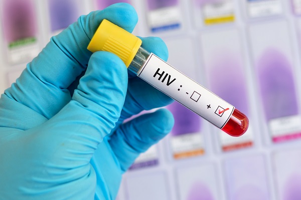 test HIV cu rezultat pozitiv
