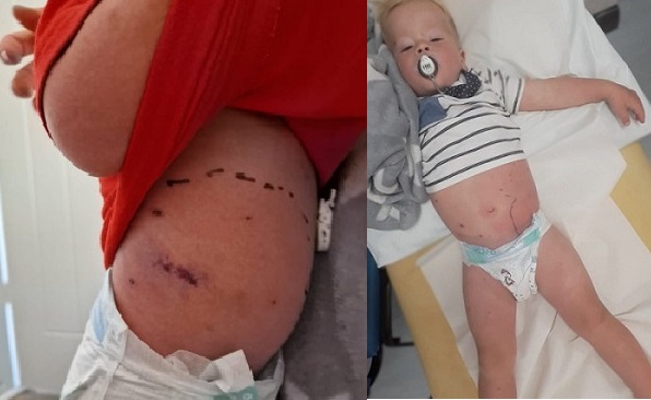baietel in spital cu diverse urme pe abdomen din cauza unei complicatii generate de administrarea unui medicament