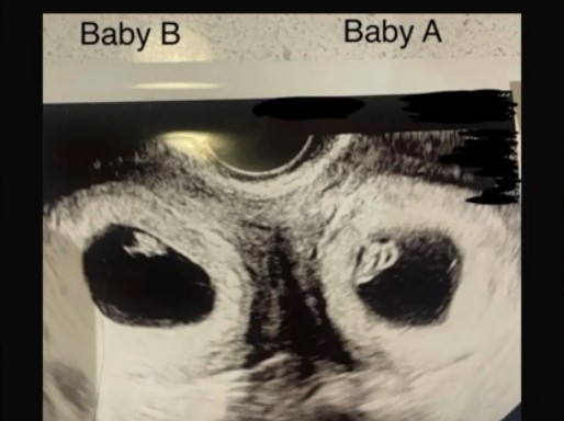 imaginea provenita de la o ecografie ce arata doi gemeni in doua utere diferite