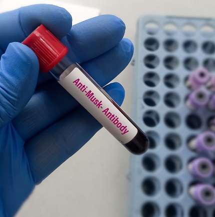 laborant cu manusi, care tine in mana o eprubeta cu o proba de sange pentru detectarea anticorpilor anti-Musk