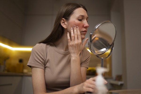 femeie cu tenul afectat de rozacee privindu-se in oglinda