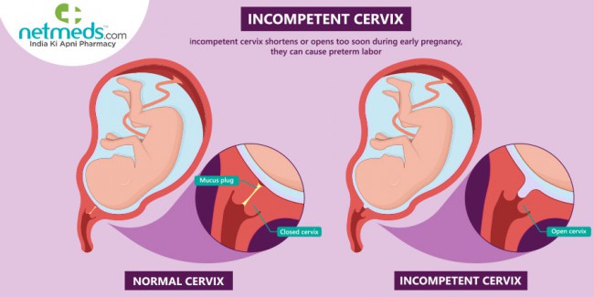 col uterin deschis prematur vs col uterin normal