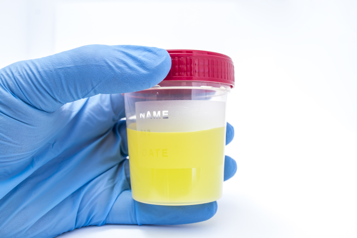 recipient cu urina pentru analize