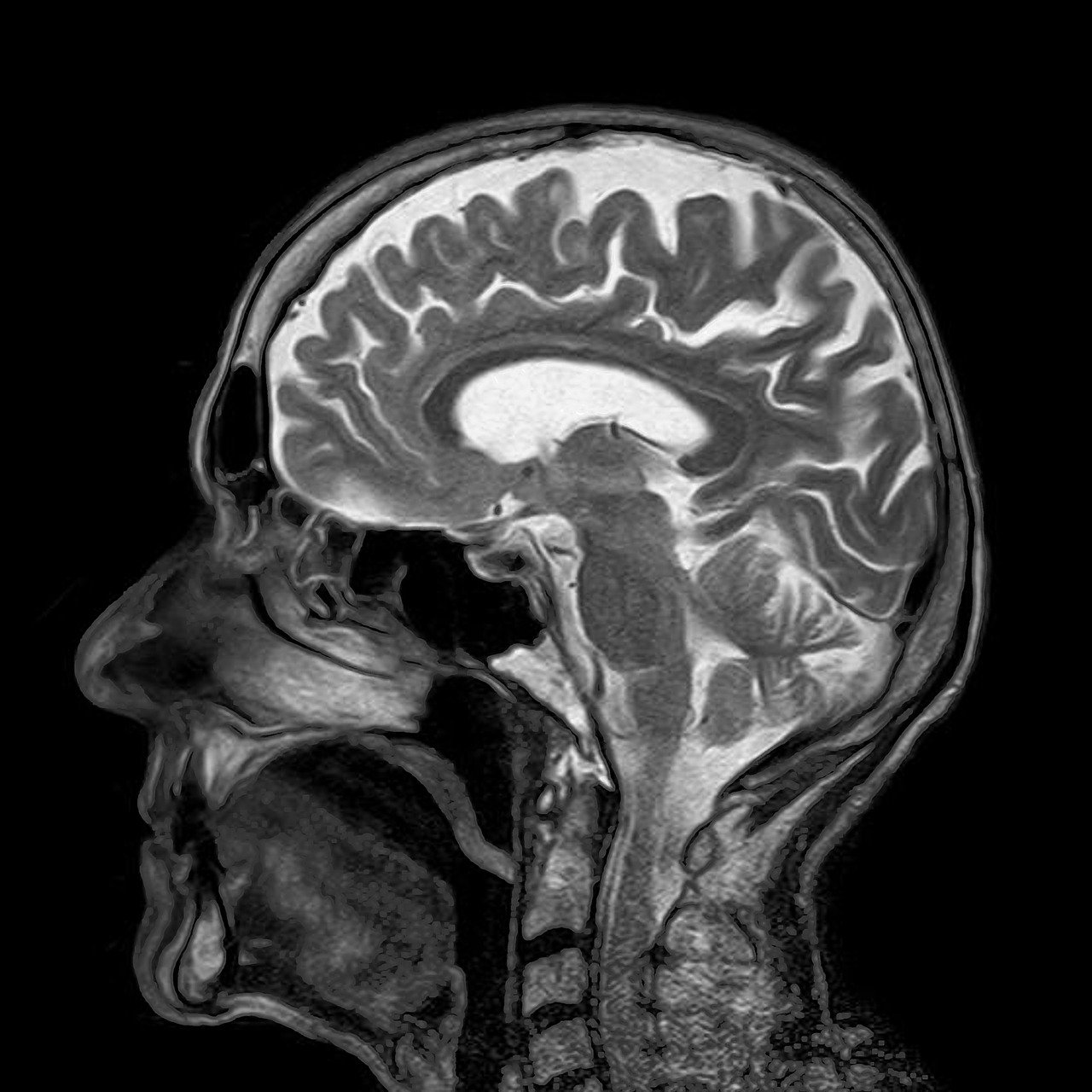diferenta dintre CT si RMN- creier vazut la RMN