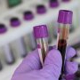 Cercetătorii au dezvoltat un test de sânge care îți spune dacă vei muri în 10 ani