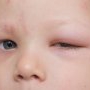 De ce se umflă ochii la copii: cauze, tratament și prevenție
