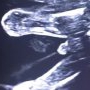 Moment unic surprins la ecograf: bebeluș făcând pipi în uterul mamei lui