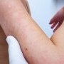 Intoxicație alimentară pe piele: cum o recunoști și ce trebuie să faci?