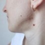 Papiloame pe gât: cauze și tratament