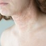 Dermatita exfoliativă: cauze, simptome și tratament