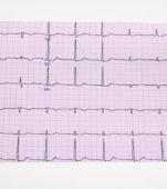 Totul despre aritmia cardiaca