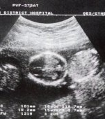 O femeie, o sarcina, 2 utere, 3 bebelusi