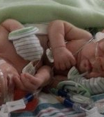 Gemenii siamezi nascuti in decembrie au trecut cu bine de prima operatie de separare