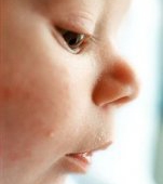 Cauzele acneei la bebelusi 