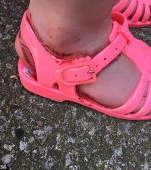 Mare grijă la săndăluțele de plastic pentru copii. Iată ce a pățit această fetiță