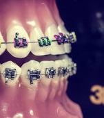 Când și de ce copilul tău poate avea nevoie de aparat ortodontic
