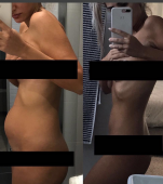 Fotografia reală care dezvăluie realitatea cruntă a endometriozei