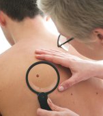 Cum îţi dai seama dacă aluniţele tale sunt cancerigene