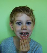 Streptococcus Mutans, monstrul din gura copiilor noștri