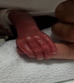 Se întâmplă miracole! Bebelușul născut cu mâna cât o monedă a sărbătorit primul an de viață
