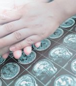 Tumorile cerebrale, principala cauză oncologică de deces din România