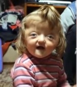 O fetiță de 2 ani nu a fost primită la creșă pe motiv ca înfățișarea ei sperie copiii