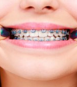 Aparatul dentar pentru copii: avantaje, tipuri și recomandări