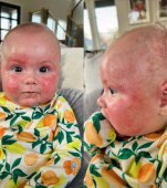 Realitatea crizei de lapte praf: o mamă publică poze cu bebelușul ei alergic