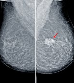 Microcalcificări la sân: ce sunt și când ar trebui să te îngrijoreze