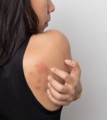 Alergii ale pielii pe sistem nervos: ce trebuie să știi