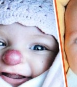 Fetița "Rudolf", care a venit pe lume cu nasul roșu, a devenit o adolescentă superbă! Transformarea este uluitoare