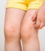 Mușcătura de furnică la copii: simptome și tratament