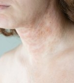 Dermatita exfoliativă: cauze, simptome și tratament