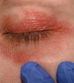 Sindromul Netherton: cauze, simptome și tratament