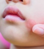 Boala obrajilor pălmuiți: cauze, simptome și tratament