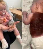 O fetiță s-a născut cu o formă extrem de gravă de nev congenital non-neoplazic, care îi acoperă în totalitate spatele. „E un caz extrem de rar, 1 la un jumătate de milion"