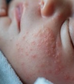 Bebelușul și erupțiile de pe piele. Cum recunoști dermatita de scutec, alergiile sau iritațiile obișnuite