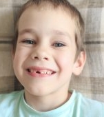 Ocluzie dentară la copii: cauze, simptome și tratament