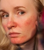 Prurigo actinic: cauze, simptome si tratament