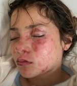 Atenție la trendurile de pe TikTok! O fetiță de 10 ani a suferit arsuri extrem de grave la nivelul feței după ce a pus o jucărie de plastic la microunde