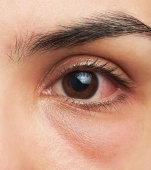 Ocluzia vasculară retiniană: cauze, simptome și tratament