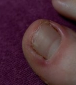Paronichia: cauze, simptome si tratament