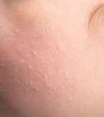 Hiperplazie sebacee: cauze, simptome și tratament